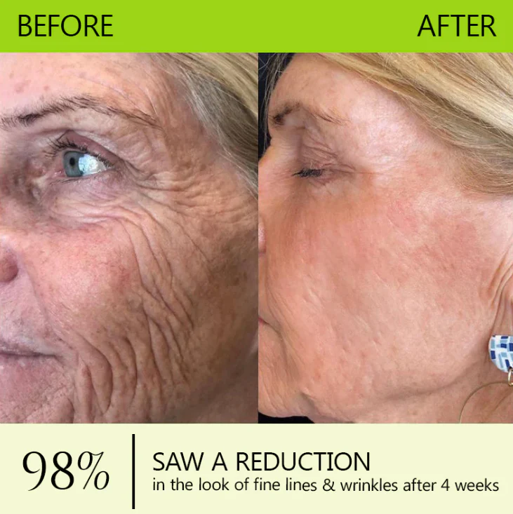Botox & Retinol Shot - Eraser for Deep Wrinkles, Sagging Jowls & Puffy Eyes - Image 3