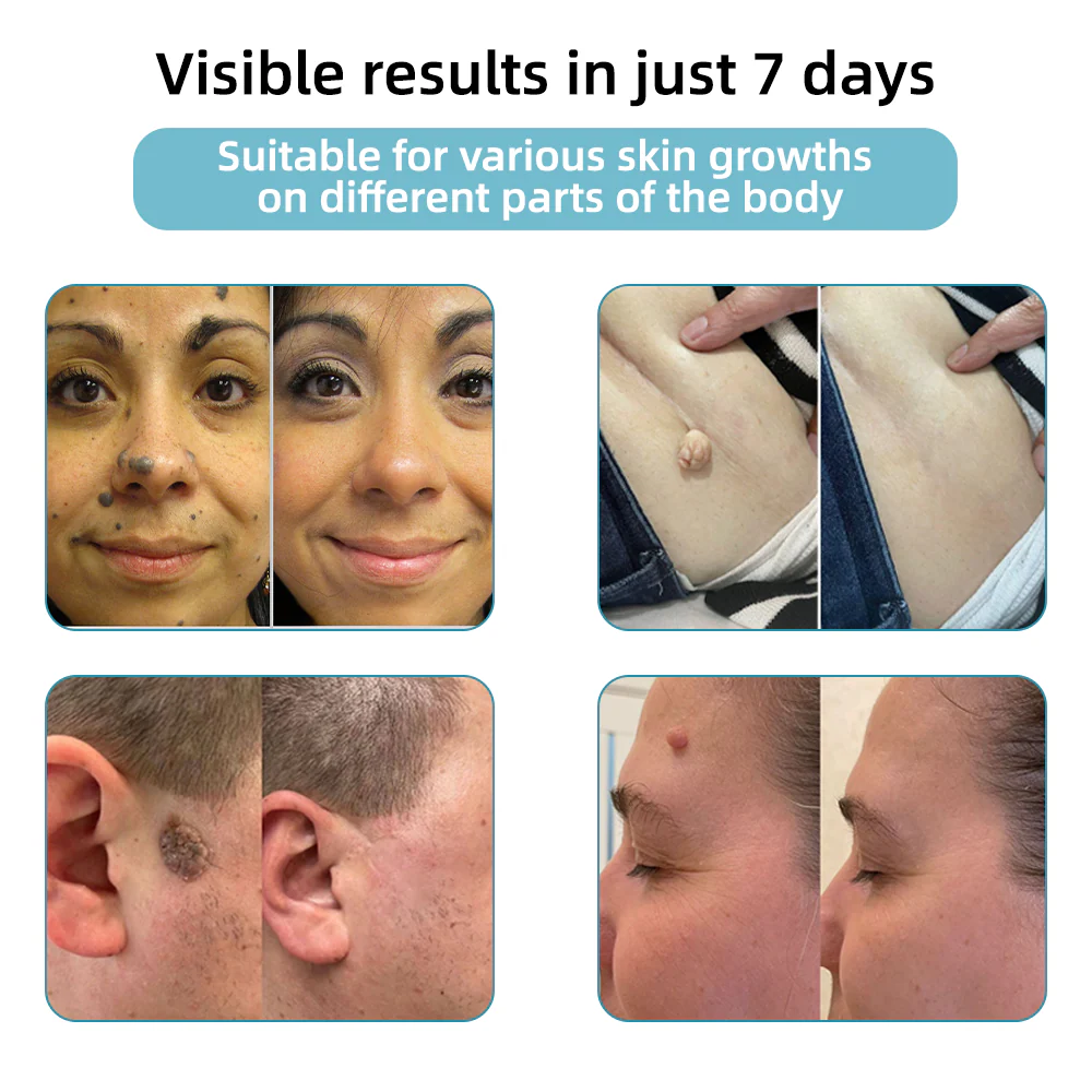 Aprolo™ Non-invasive Mole and Wart Removal Laser Pen - Image 2