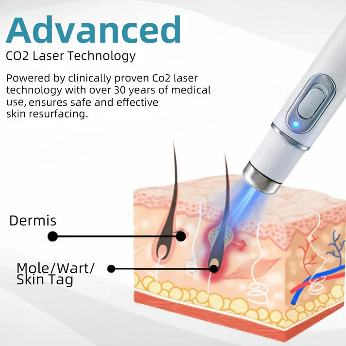 Aprolo™ Non-invasive Mole and Wart Removal Laser Pen - Image 8