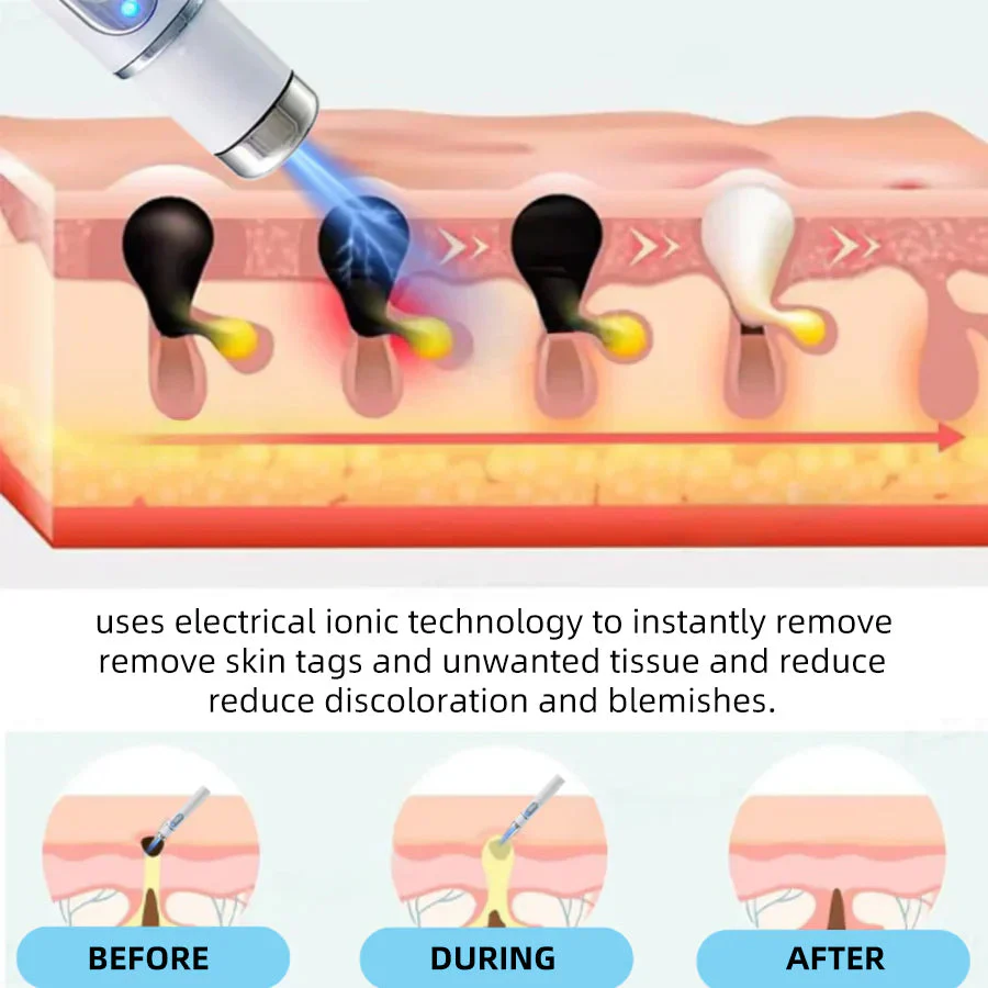 Aprolo™ Non-invasive Mole and Wart Removal Laser Pen - Image 9